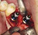   Piezo Implant Bone Surgery Motor Dental NEW. 11 Tips included  