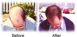 Procerin is a vitamin for hair loss that is specially formulated to 